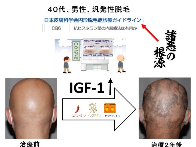 円形脱毛症　病院